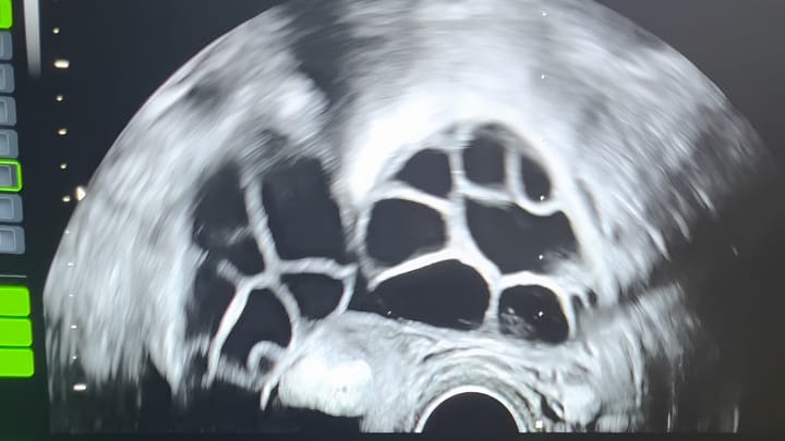 A screenshot of a pre-egg collection ultrasound scan of two hormonally stimulated ovaries. 